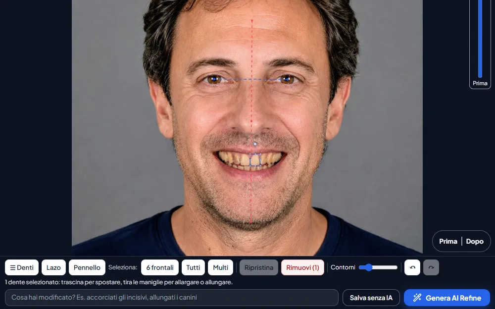 Il Designer di SmileLive: un dente selezionato con le maniglie, gli strumenti Denti, Lazo e Pennello e il tasto per la rifinitura con IA